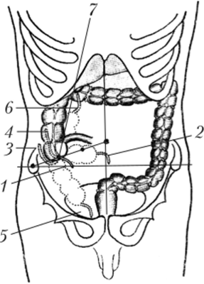 Схема вариантов анатомического расположения червеобразного отростка.