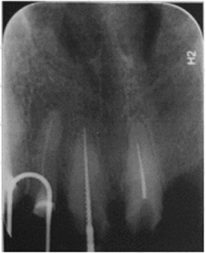 Визиограмма. Пациент О., 67 лет, продолжение. Коронки сняты. Во время прохождения корневого канала зуба 2.1 файл КЗ № 30 сломался в корневом канале.