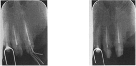 Визиограмма. Пациент О., 67 лет, продолжение. Рентгенконтроль пломбирования корневых каналов зубов 1.1 и 2.1. В корневом канале зуба 2.1 гуттаперчевые штифты.