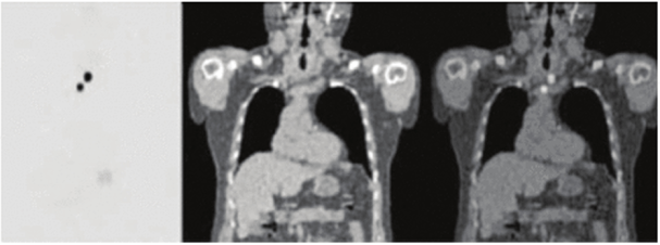 Рис. 16. Система ПЭТ/КТ в диагностике рака щитовидной железы. Скан ПЭТ показывает наличие опухолей (з и 5 мм, самая ранняя стадия, метастаз нет), но нет точной локализации. Скан КТ не обнаруживает никаких признаков опухоли. Скан ПЭТ/КТ - одновременное сканирование показывает наличие опухоли и точное расположение.