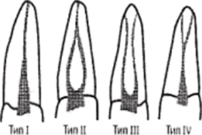 Классификация Вайна, четыре типа корневых каналов в корне зуба.