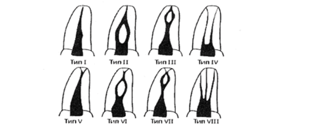 Классификация Вертуччи, восемь типов корневых каналов.