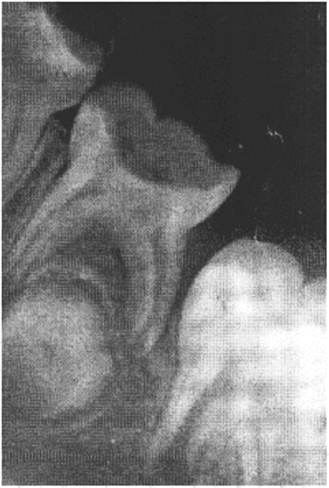Ребенок К., 6 лет. Рентгенограмма. Зуб 8.5 имеет кариозную полость, между корнями расположен фолликул постоянного зуба.