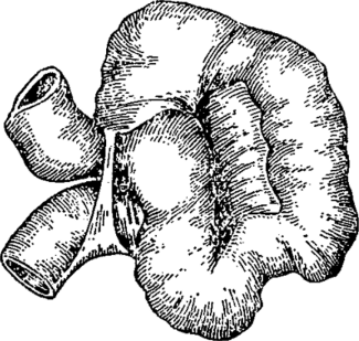 Странгуляционная форма ileus — ущемление тяжом (Treves).