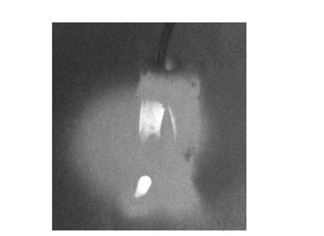 Глубокое фторирование тканей зуба, активация лазерным излучением, проникновение излучения в окружность зуба.