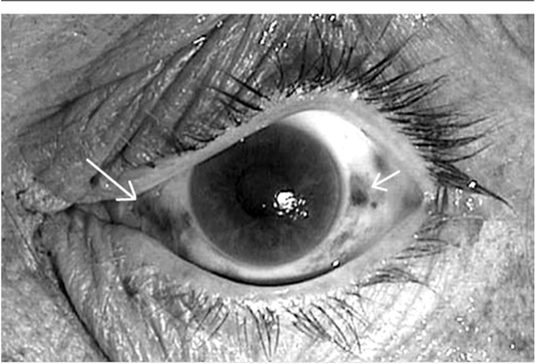 Кровоизлияния в глаза (указаны стрелками).