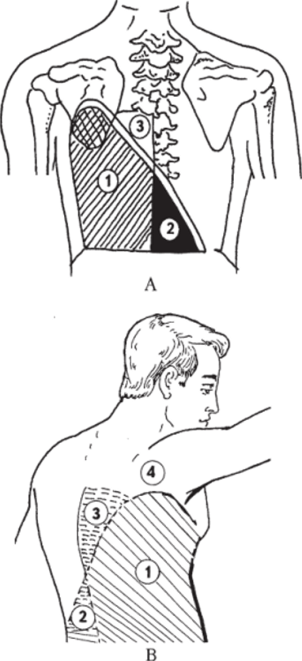 Треугольник Гарлянда и Раухфуса — Грокко Апередняя поверхность, В - боковая поверхность грудной клетки.