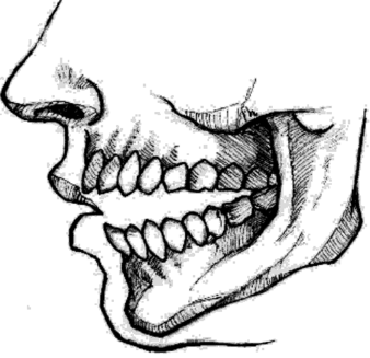 Открытый тип прикуса и соответствующая им форма смыкания губ.