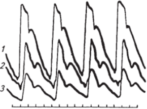 Сфигмограммы сонной (7), лучевой (2) и пальцевой (Э) артерий, записанные синхронно.