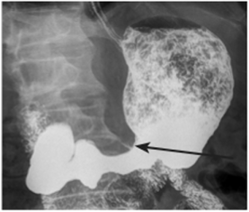 Рентгенологическая картина опухолевого процесса при язве желудка.