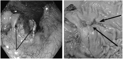 Эндоскопическая картина малигнизированных язв желудка.