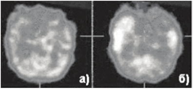 На ОФЭКТ головного мозга выявляется область гипоперфузии в межириступный период.