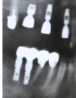 №16. Фрагмент ОПТГ с коротким имплантатом 5-6 мм и имплантатами 8 мм вокруг шейки которых проводилось измерение микроциркуляции.