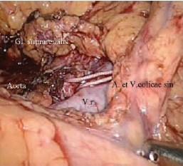 Брыжейка ободочной кишки рассечена; выделены сосуды левой почки. A.r.почечная артерия, вокруг которой проведена капроновая лигатура; V.r.почечная вена.