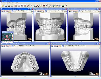 Технология автоматизированного проектирования и изготовления зубных протезов с применением 3 D технологии.