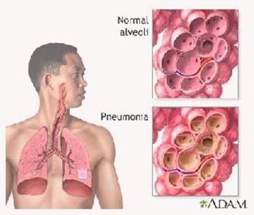 Альвеолы в норме и при пневмонии.