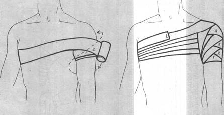 Колосовидная повязка на плечевой сустав.
