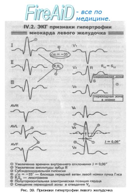 Признаки гипертрофии миокарда левого желудочка.