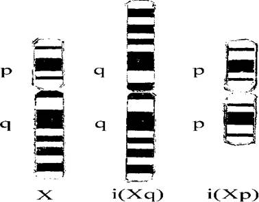 Изохромосомы Х по длинному [i(Xq)] и короткому [i(Xp)] плечу.