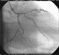 Хирургическая анатомия коронарных артерий сердца.