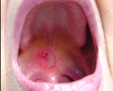 Травматические повреждения слизистой оболочки полости рта у детей.