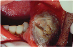 Травматические повреждения слизистой оболочки полости рта у детей.