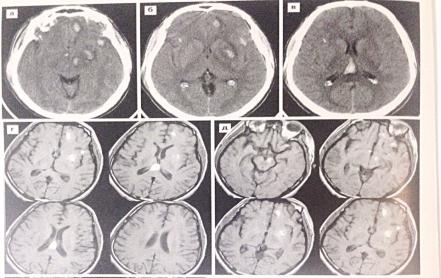 ДАП у больного с тяжелой ЧМТ. КТ (а, б, в) и МРТ в режиме Т1. Множественные геморрагические фокусы с поражением мозолистого тела.