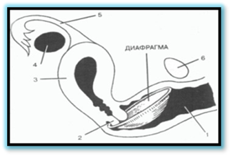 Расположение диафрагмы во влагалище. 1 - влагалище; 2 - шейка матки; 3 - тело матки; 4 - яичник; 5 - маточная труба; 6 - лобковая кость.