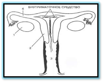 Расположение внутриматочного средства в полости матки. 1 - яичник; 2 - тело матки; 3 - влагалище; 4 - маточная труба.