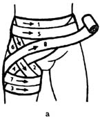 Передняя колосовидная повязка области тазобедренного сустава.