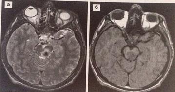 МРТ на 2 сутки после травмы - визуализирует зону измененного сигнала от острой микрогематомы в проекции среднего мозга слева.