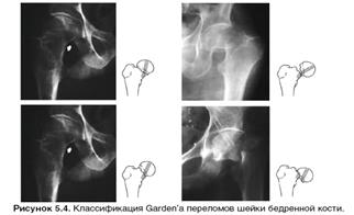 Классификация переломов шейки бедренной кости по Garden.