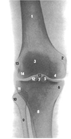 Коленный сустав, правый. Вид спереди (рентгеновский снимок).