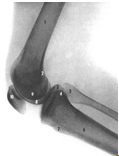 Коленный сустав, правый (рентгеновский снимок). (Коленный сустав в состоянии сгибания).