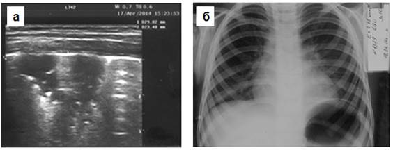 Рентгенонегативная пневмония в S 8 слева в день госпитализации.