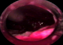 Видеторакоскопическая картина свободной плевральной полости после выполненного ВТЛ.