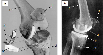 Схема установки (а) и рентгенограмма (б) имплантированного санного эндопротеза .