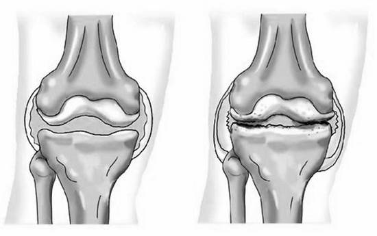 Коленный сустав в норме (слева) и коленный сустав, пораженный артрозом.
