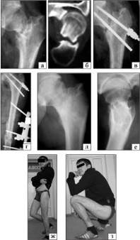 Рентгенограммы и клинический результат больного Д.