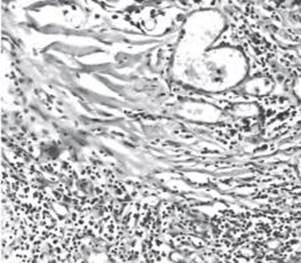 Инфильтрация лимфоцитами, гистиоцитами и плазматическими клетками на фоне фиброза во второй группе экспериментальных животных, 3-я неделя. Окраска.