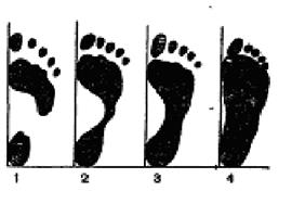 Отпечатки нормальной (1, 2, 3) и плоской (4) стопы.