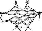 Схема наложения лигатур при экстирпации матки:1 - на брызжейку яичников, 2 - на сосуды маточных связок, 3 - на тело матки.