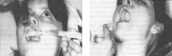 Проведение плексуальной анестезии для удаления резцов. Рис. 6. Проведение палатинальной анестезии справа.