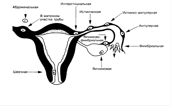 Внематочная беременность. Внематочная беременность: причины и лечение.