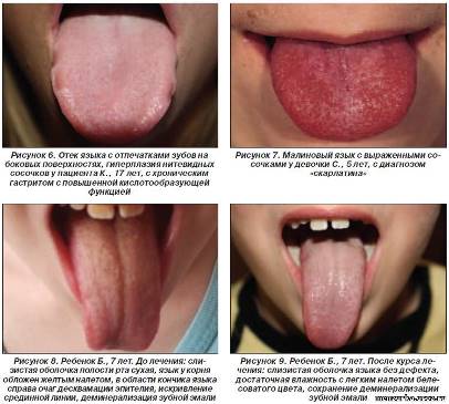 Диагностика заболеваний по языку.