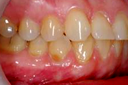 Зубные ряды пациента с абфракционными дефектами и трещинами эмали зубов, рецессией десны.
