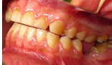 Зубные ряды пациента с фасетками истирания зубов, сколами реставрационного материала.
