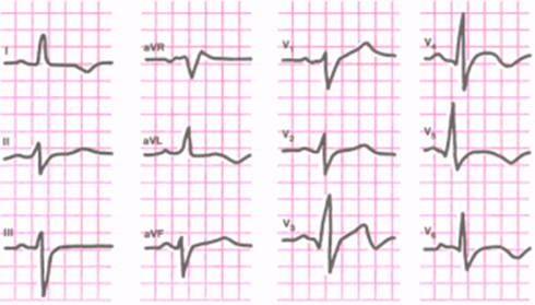 Электрокардиограмма при инфарктах миокарда передней стенки левого желудочка.