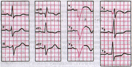 Рис. 4. ЭКГ при переднеперегородочном и верхушечном инфаркте миокарда: а - схема возникновения инфаркта, б - ЭКГ.