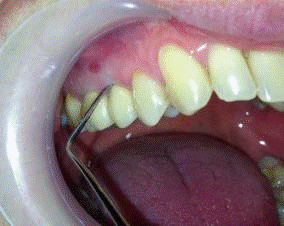 Результаты прочностного анализа системы «зуб-штифтовая культевая вкладка-литая коронка».